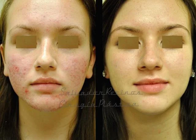 Elimina las Cicatrices de los Granos Con nuestros tratamiento Laser CO2 Fraxel