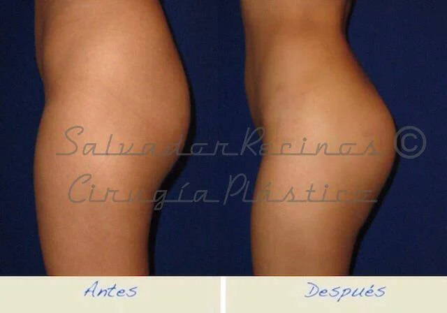 Glúteos firmes ahora pueden ser una realidad.