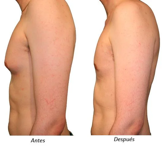 Ginecomastía