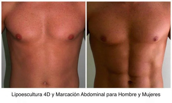Lipoescultura de Alta Definición 4D