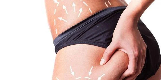 Lipoescultura - Liposucción