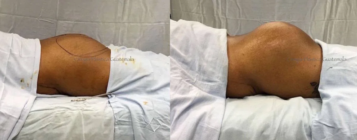 Luce sexy! Con un Aumento de Glúteo.