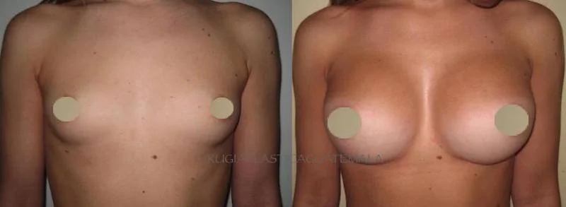 AUMENTA TÚ BUSTO A CUALQUIER TALLA !!!