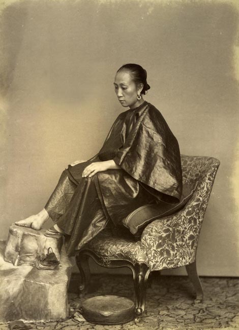 Chinese woman with feet re-shaped by years of binding.