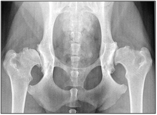 Hip dysplasia and osteoarthritis present in both hips.png