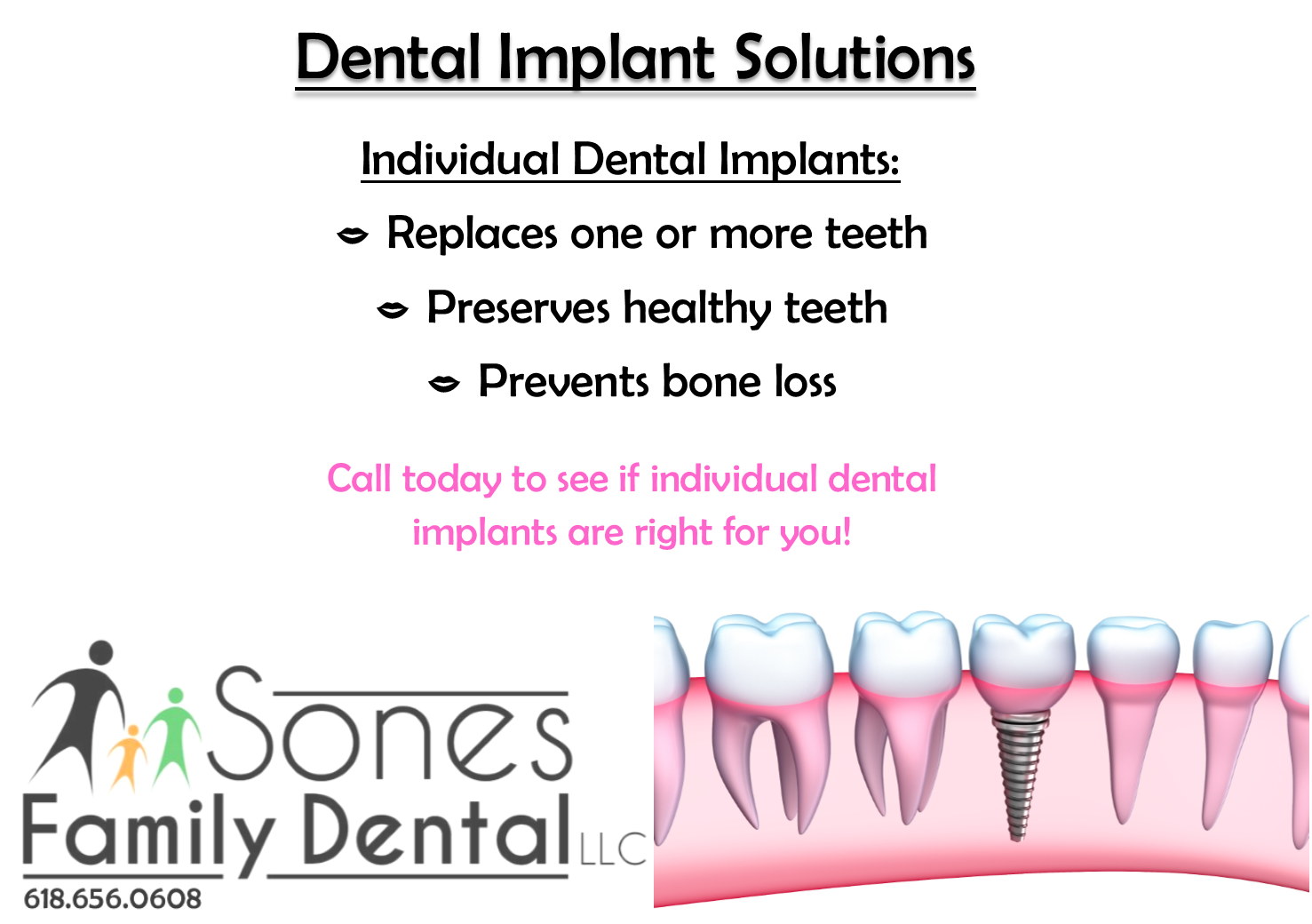 dental implants sol 1.png