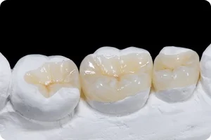 inlay_onlay02.jpg