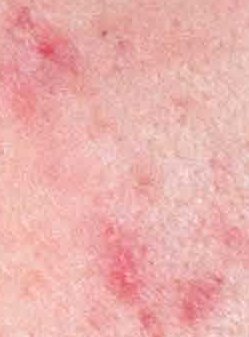Harsh chemicals can cause redness, sensitivity and irritation