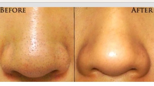 Use of clay to detox pores