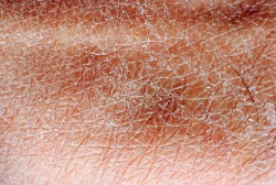 Dry skin: skin lacking oils or natural hydrators