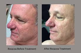 Here is an example of a before and after treatment.