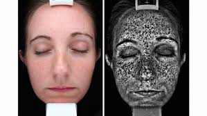 This image shows skin in a normal view on the left and on the right a woods lamp tool is used to see the sun damage beneath the surface.