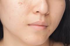 Dark marking and scarring caused by inflamed breakouts.