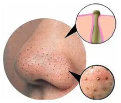 Blackheads are easily removed after steam and exfoliation.