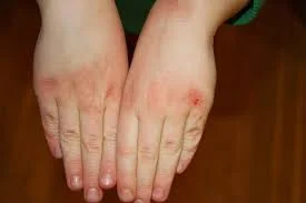dry cracked hands.jpeg