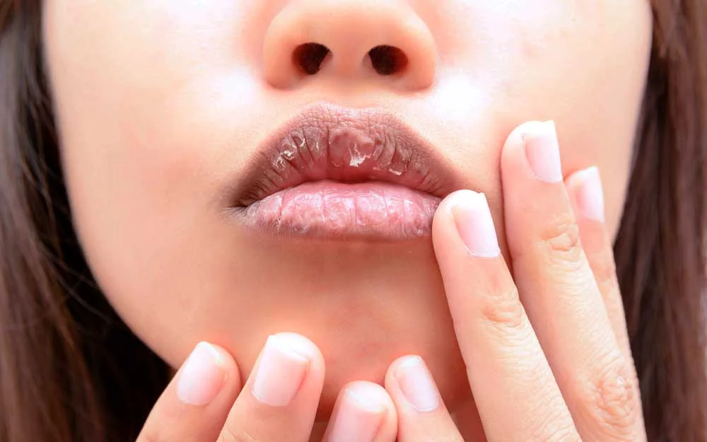 chapped lips.jpg