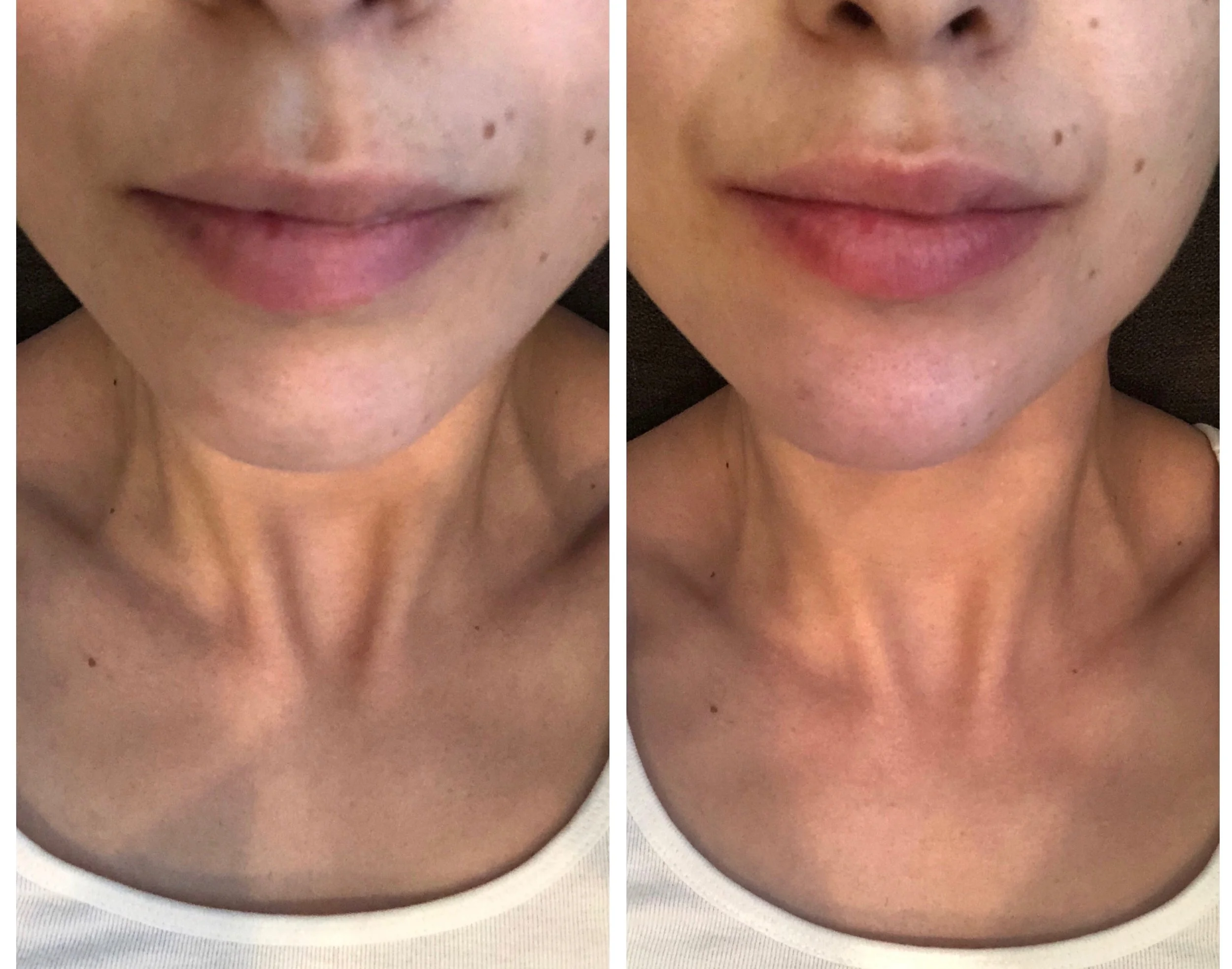 On the left is before treatment and on the right is after brushing lips with solution for 1.5 minutes.