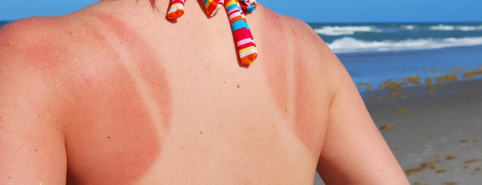 apply every two hours to avoid burning