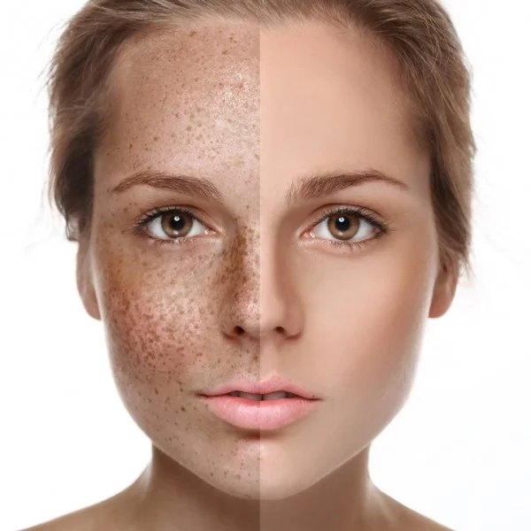 UVA rays cause long term damage like dark spotting.