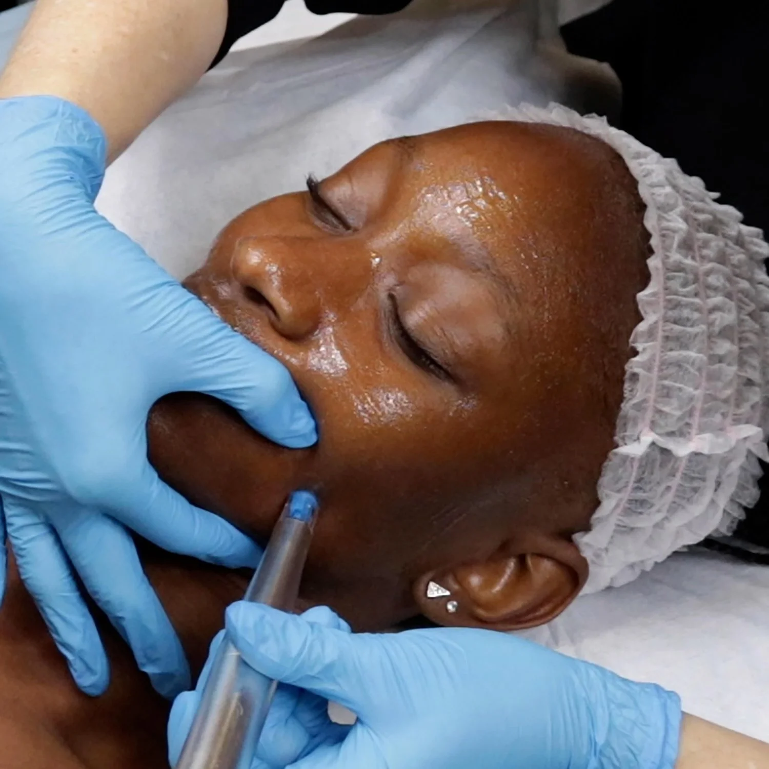 Nano Needling - Rejuvenate and Smooth Your Skin