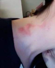 My neck, some years ago, post spider bite. The face, you'll note, is only a few steps north.