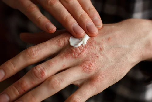 August is Psoriasis Awareness Month