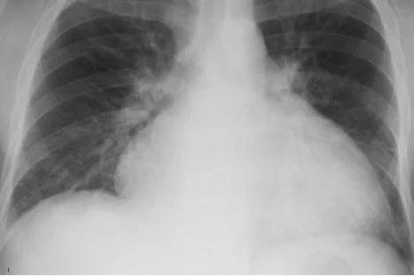 Cardiomegaly - Is my heart killing me?