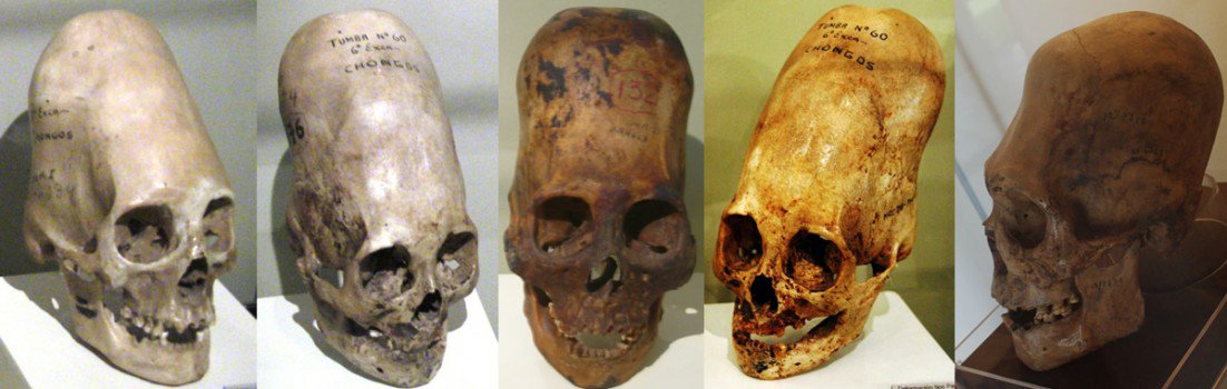 Elongated skulls found in Peru’s Paracas Peninsula. Image by Brien Foerster, via Collective Evolution.