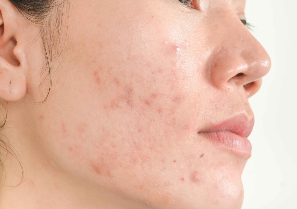 Misbrug Tick aspekt Why is my skin so bad? — Moody Sisters Skincare