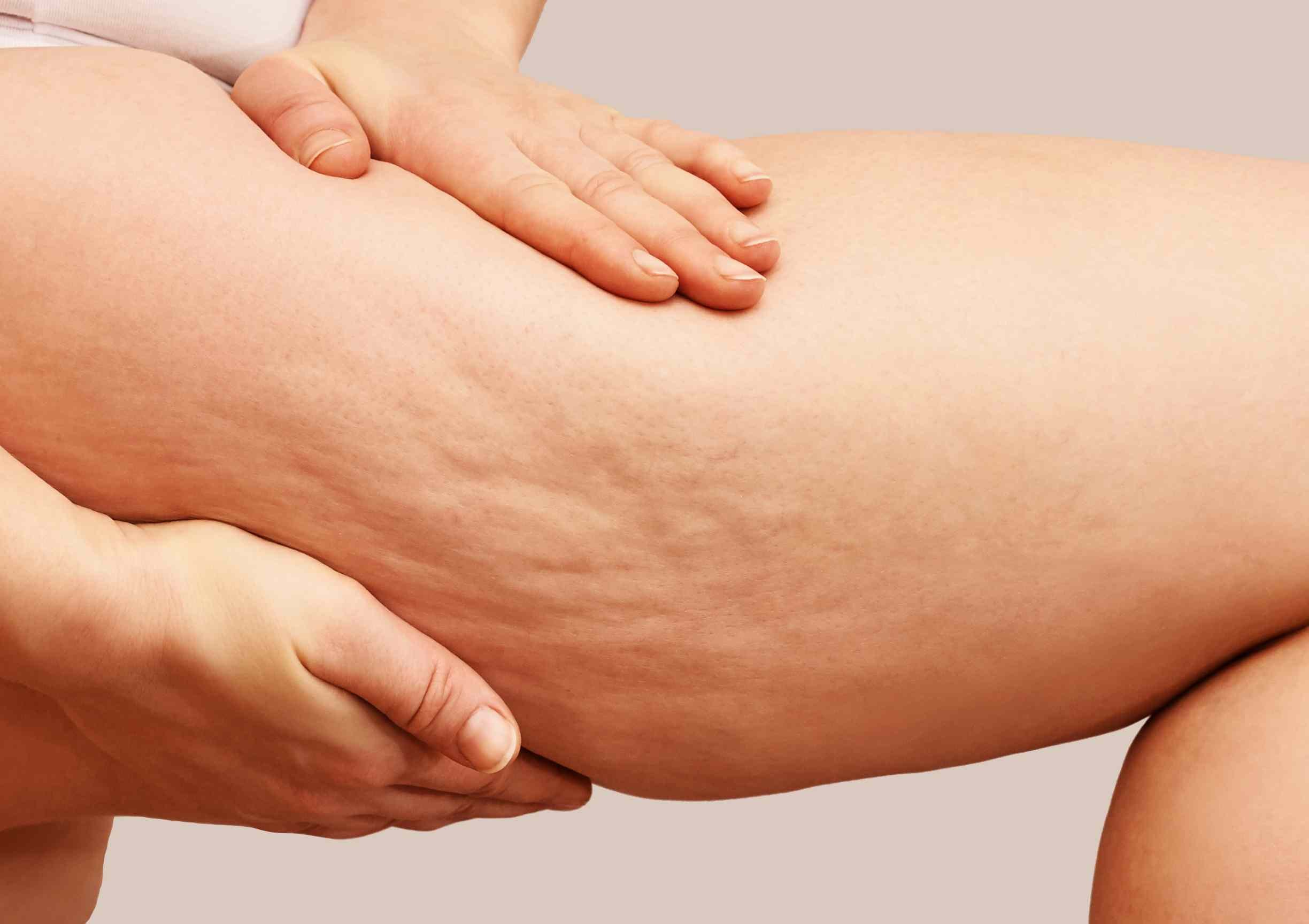 The Ultimate Guide to Get Rid of Cellulite Naturally — Moody Sisters ...