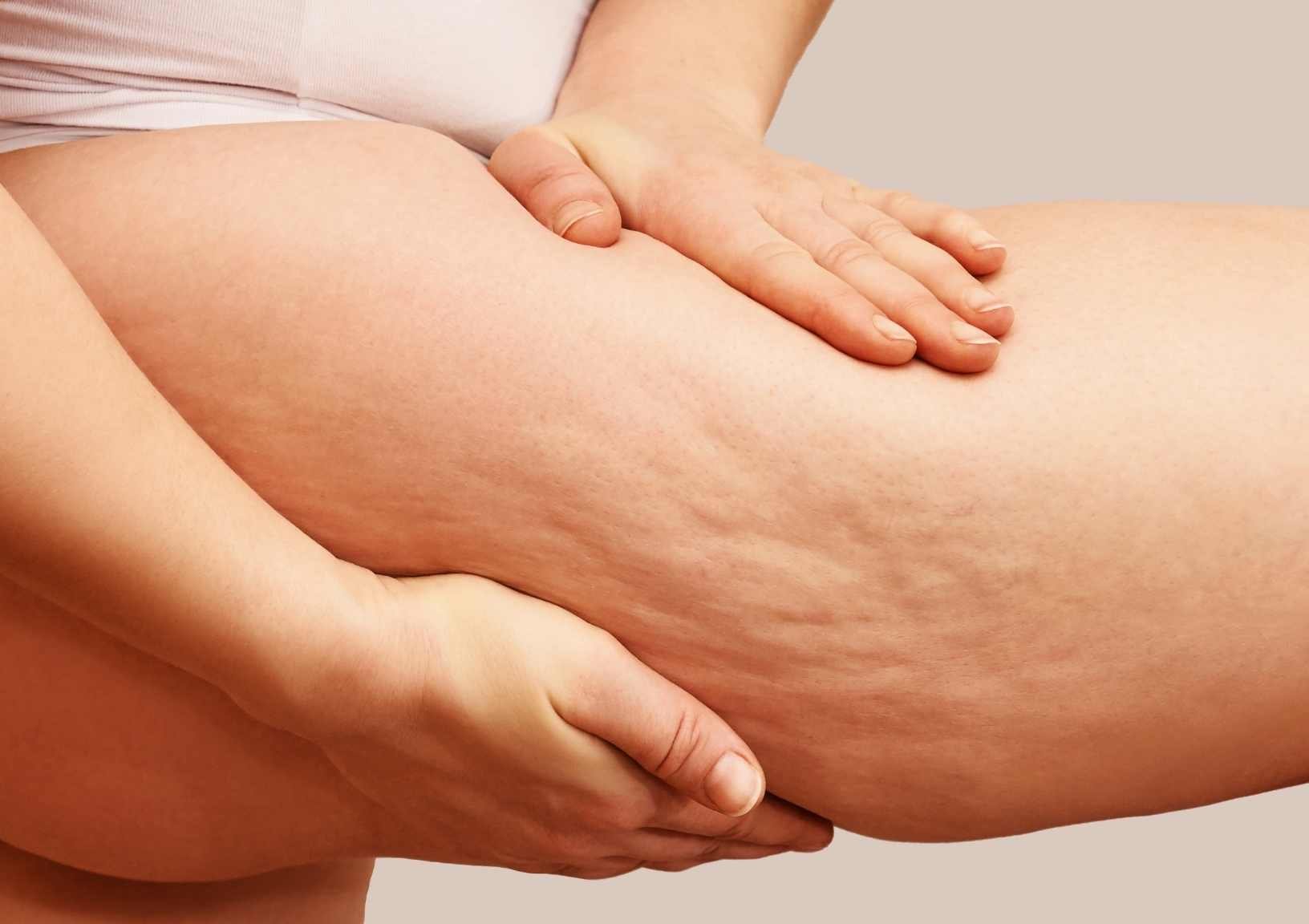 What is cellulite? And what causes it? — Moody Sisters Skincare