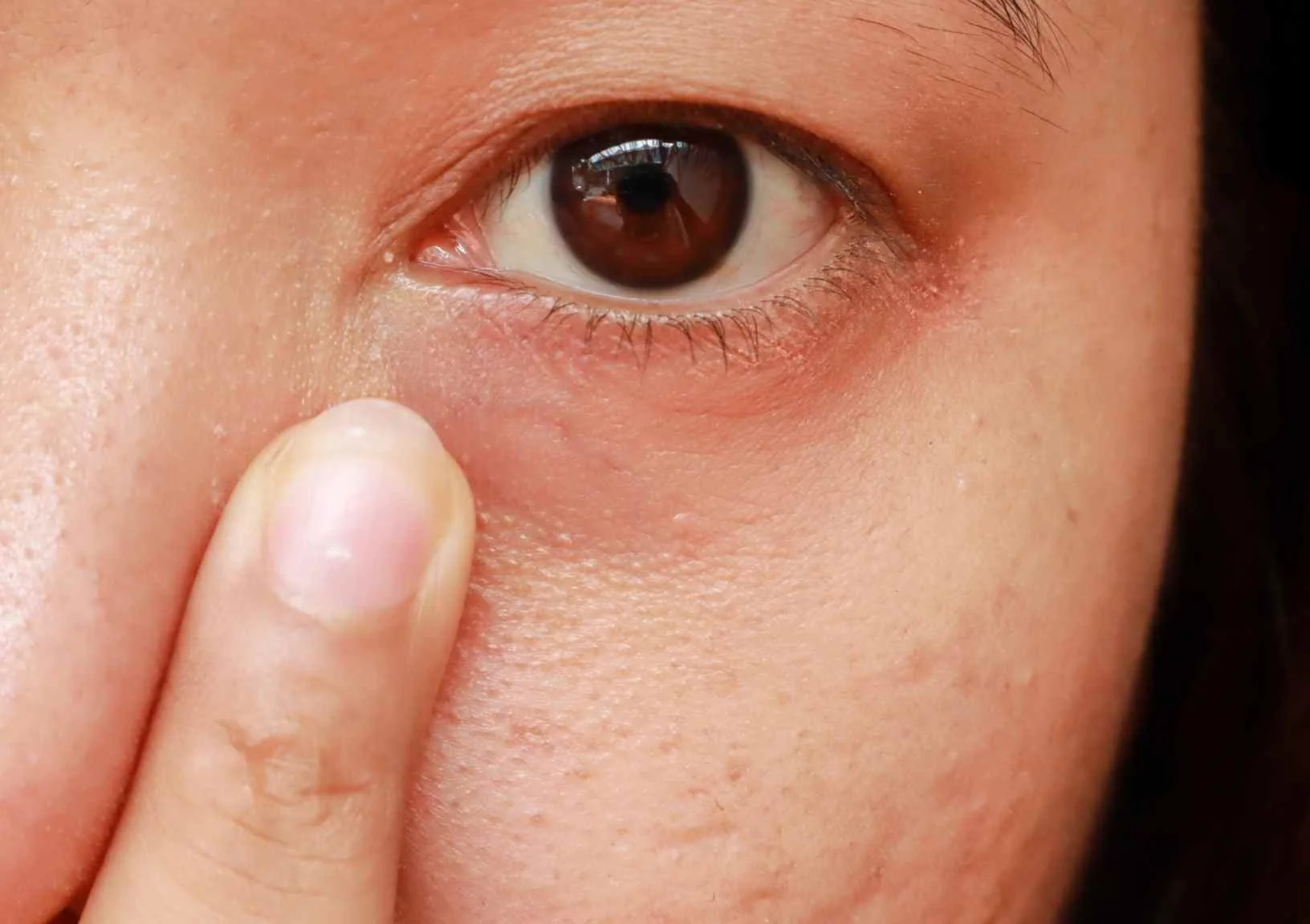 What Helps Dark Circles Under Eyes — Moody Sisters Skincare