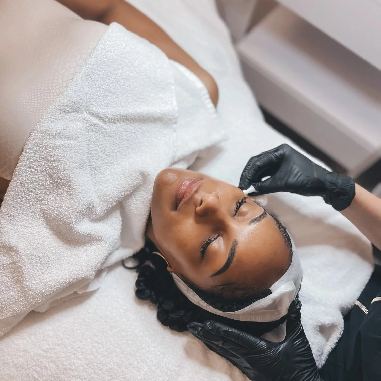 True Beauty TCA peel 