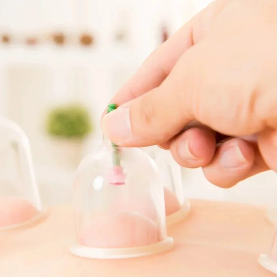 Cupping Therapy