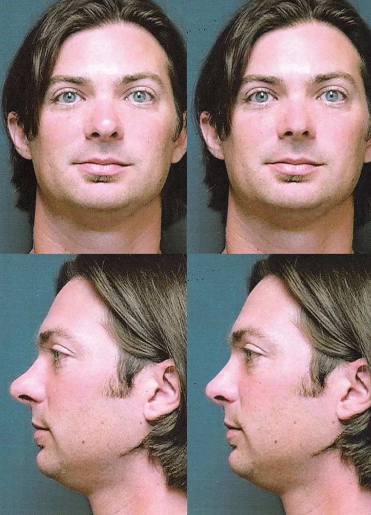 Rhinoplasty2.jpg