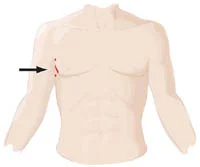 Incision for Robotically Assisted Mitral Valve Repair