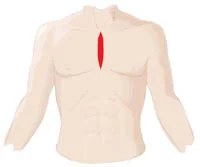 Traditional or Open Heart Incision