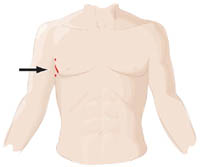 Robotically Assisted Incision