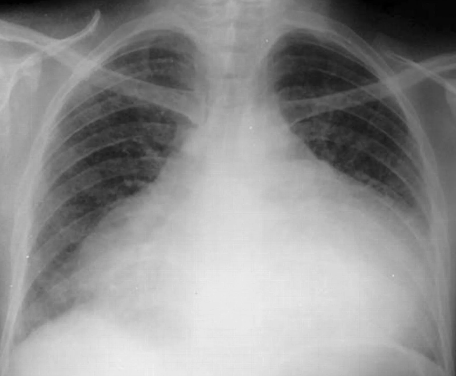 Chest x-ray of patient with severe dilated cardiomyopathy