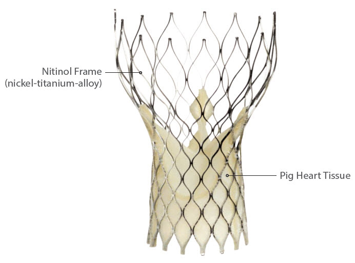 CoreValve TAVR treatment for Severe Aortic Stenosis (AS)