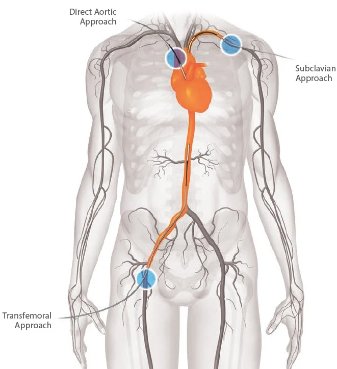 CoreValve TAVR Femoral Approach