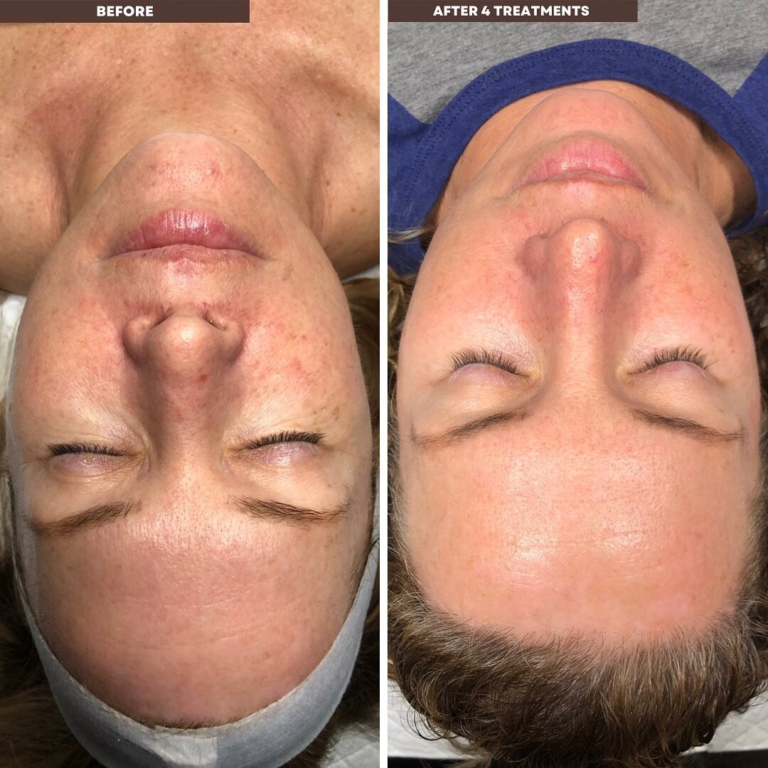 4 Collagen Induction Therapy Treatments&hellip; 🤯🤩
How have you not booked yours yet?! Look at that almost airbrushed looking skin. It&rsquo;s brighter, tighter, showing less texture &amp; less redness. And just look at the eye area! 🤩

Also known