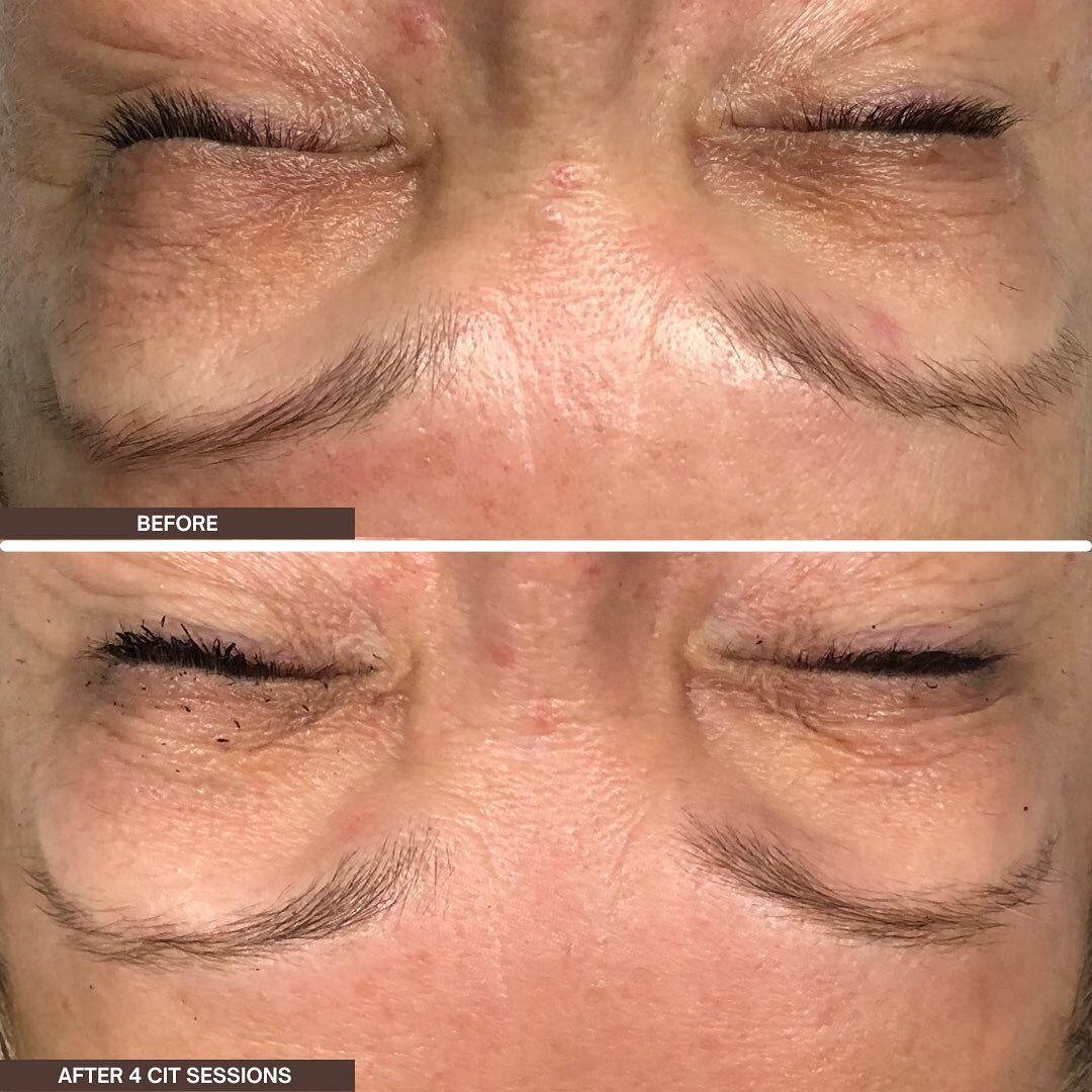 ᴄᴏʟʟᴀɢᴇɴ ɪɴᴅᴜᴄᴛɪᴏɴ ᴛʜᴇʀᴀᴘʏ
the best anti-aging treatment!

AKA micro-needling, is a minimally invasive skin-rejuvenation procedure that produces new collagen &amp; elastin. 

Improve your skin texture &amp; firmness, as well as reduce scars, &amp; po