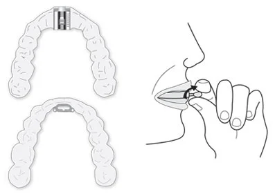 dentalappliance.jpg