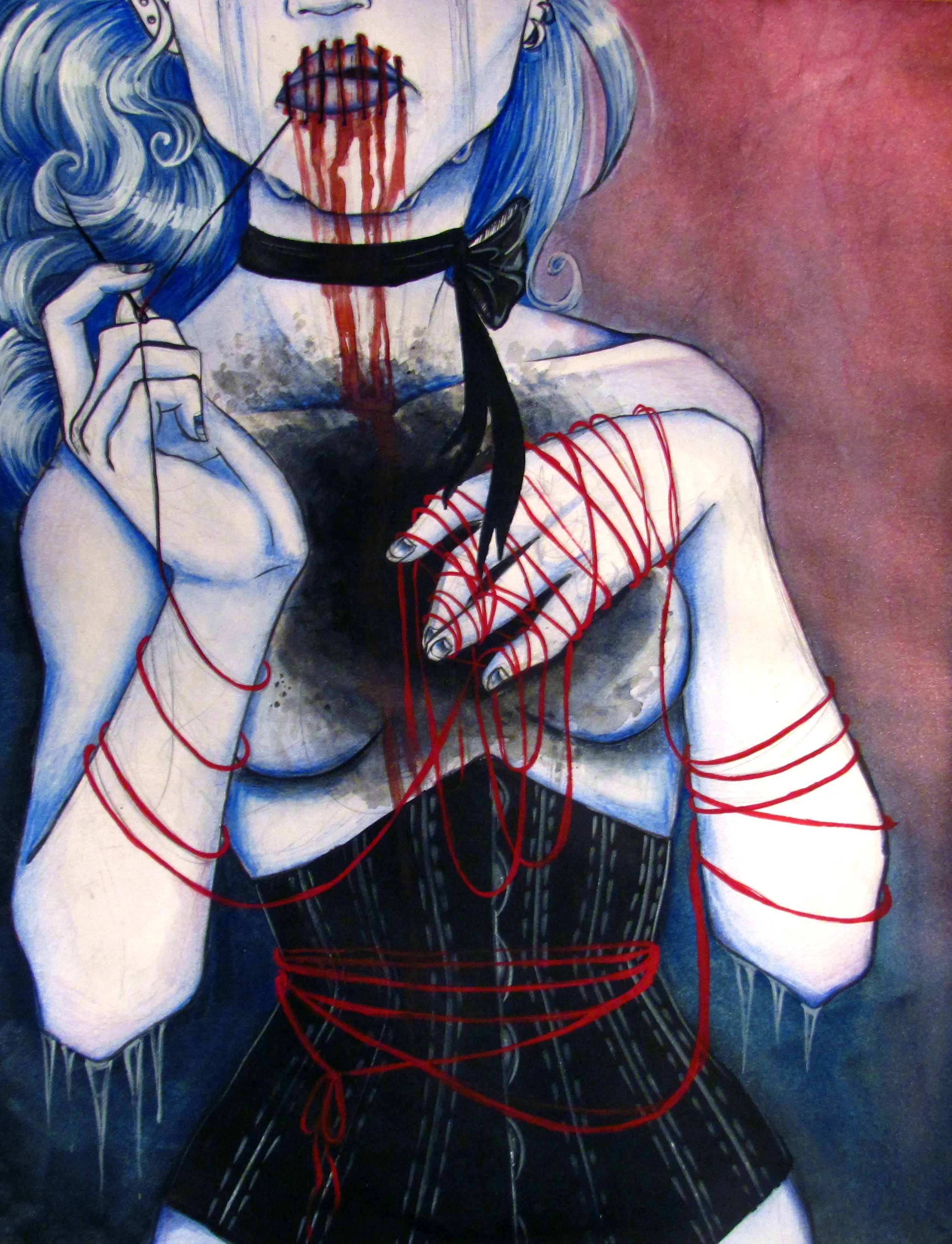 Frostbite