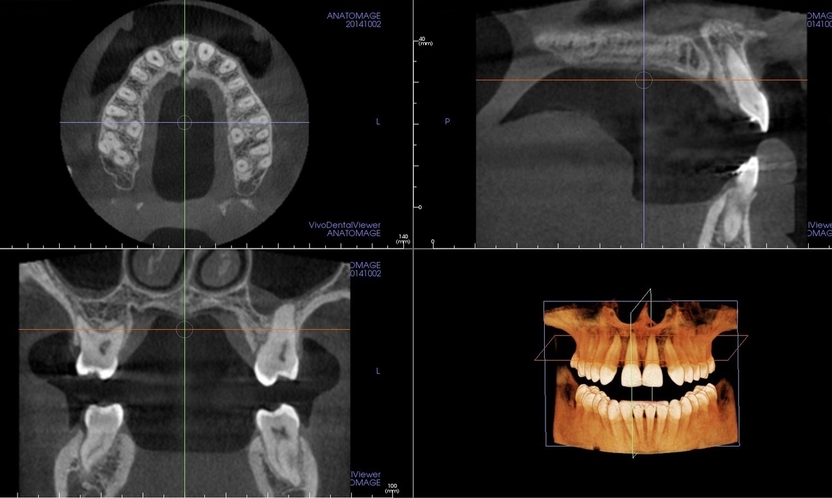 Our all digital office balances the lowest possible dose of X-rays with the highest quality images.