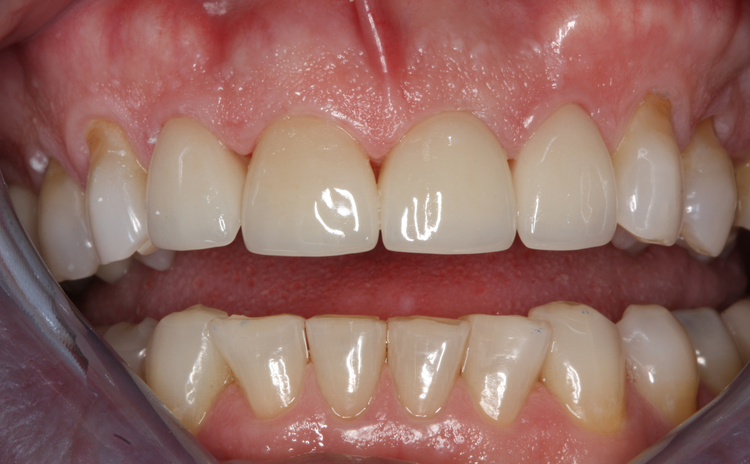 4 anterior crowns - after.png