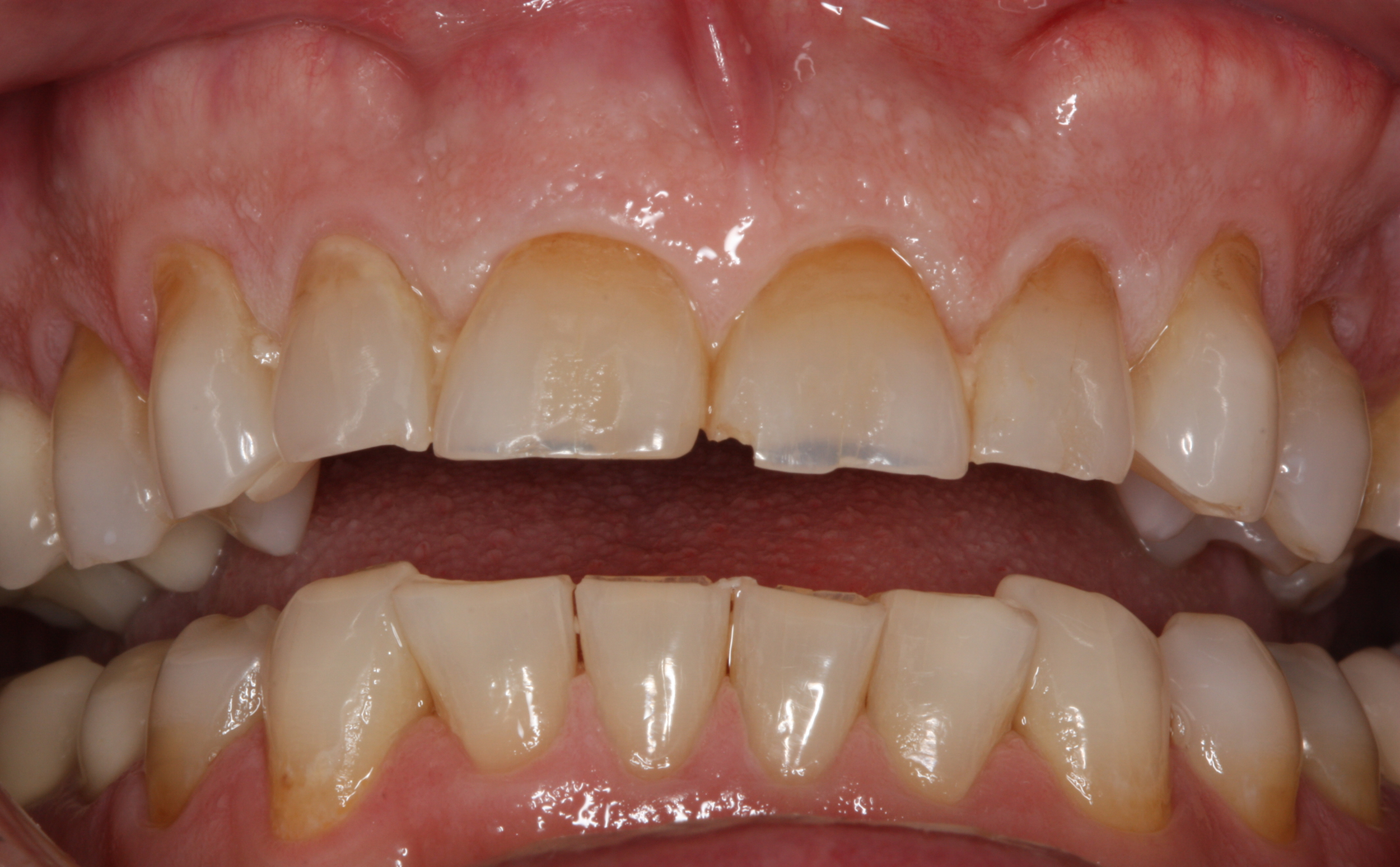 4 anterior crowns - before.png