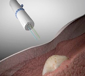 Figure 1 . The CIVO microinjection device is inserted into the tumor through the skin to quickly and precisely deliver drug micro-doses.
