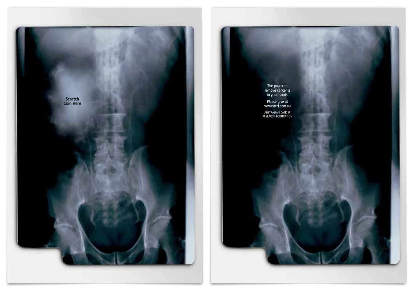ACRF Scratch Card | Lung